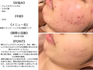 皮膚科より効果あり ⁉️最短ニキビ改善のエステ・リラクイメージ