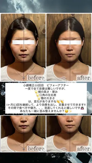 💎後悔させない小顔 矯正💎イトヤマ🌱のエステ・リラクイメージ