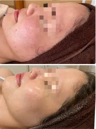 【ハーブピーリング/毛穴洗浄】NA skin 川崎店〜ニキビ・毛穴専門店〜所属・NAホワイトニング 川崎店のエステ・リラクイメージ