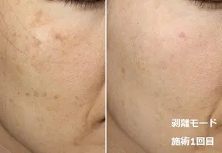 顔脱毛&毛穴&ニキビ 優良№1♪ヒロコ♪のエステ・リラクイメージ