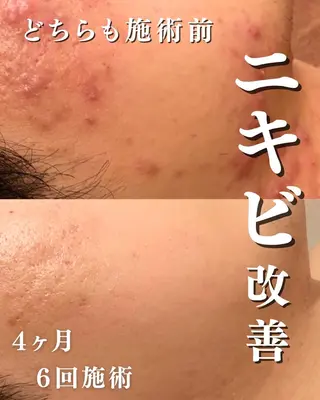 ニキビ跡改善専門🔥 医療にはできない改善のエステ・リラクイメージ