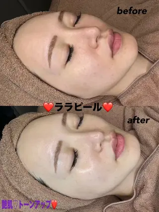 ハーブピーリング/韓国肌管理/フェイシャル/毛穴洗浄/眉毛/顔脱毛【糸脱毛専門】rev所属・肌質改善❤️美眉 脱毛🍒糸脱毛サロンのエステ・リラクイメージ