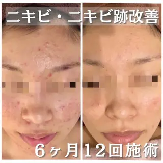 学生ニキビ改善🍀 優しい肌質改善のエステ・リラクイメージ