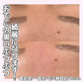 Reine BeautySalon所属・毛穴/シミ肝斑/脱毛 横山梨里のエステ・リラクイメージ