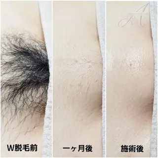 A*[エースター] シュガーリング🍋のエステ・リラクイメージ