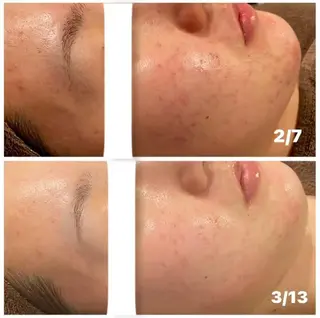 肌質改善ハーブピー リング🌿RINAのエステ・リラクイメージ