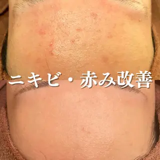 学生ニキビ改善🍀 優しい肌質改善のエステ・リラクイメージ