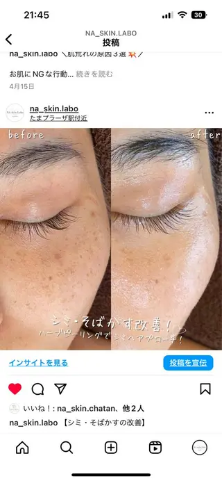 【ハーブピーリング/毛穴洗浄】NA skin 川崎店〜ニキビ・毛穴専門店〜所属・NAホワイトニング 川崎店のエステ・リラクイメージ