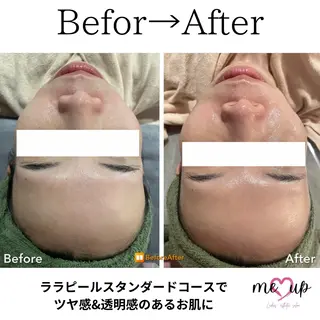 Meupニキビ専門店 背中/ハーブ/ララのその他イメージ