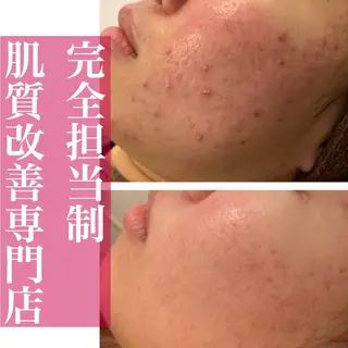 学生ニキビ改善🍀 優しい肌質改善のエステ・リラクイメージ
