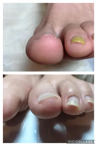 ネイル Nail ビ爪のネイルデザイン