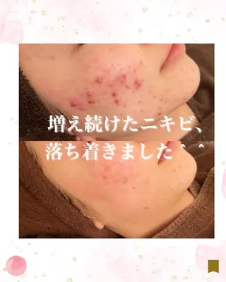 ニキビ跡専門サロン Ainaのエステ・リラクイメージ