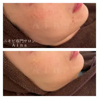 セミロング メンズ アイブロウ ニキビ跡専門サロン Ainaのエステ・リラクイメージ