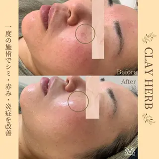 【剥離ありハーブピーリング専門エステ】cerisier BEAUTÉ 原宿所属・cerisier BEAUTÉのエステ・リラクイメージ