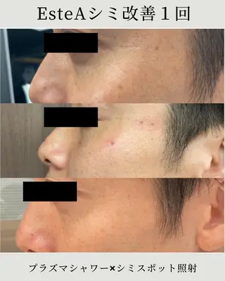 メンズ シミ毛穴ケア EsteAのエステ・リラクイメージ