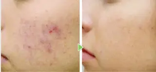 ☺ハーブピール💕 ソフィアカロン💖のエステ・リラクイメージ