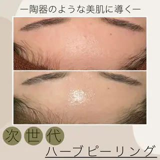 Meow！～トラブル肌専門ピーリング＆脱毛サロン～所属・トラブル肌改善🏥 Meow！🫧🫧のエステ・リラクイメージ