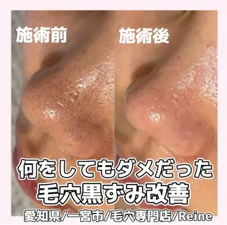 Reine BeautySalon所属・毛穴/シミ肝斑/脱毛 横山梨里のエステ・リラクイメージ