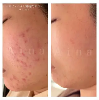 ロング カラー パーマ ヘアアレンジ メンズ キッズ ネイル マツエク・マツパ アイブロウ ニキビ跡専門サロン Ainaのエステ・リラクイメージ