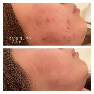 カラー パーマ ヘアアレンジ メンズ キッズ ネイル マツエク・マツパ アイブロウ ニキビ跡専門サロン Ainaのエステ・リラクイメージ