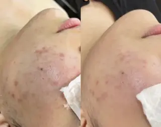 最速小顔・肌質管理 ❣️エスポワールのエステ・リラクイメージ