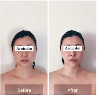 ハーブピーリング 肌再生ピーリング/のエステ・リラクイメージ