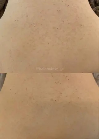 肌質改善 KALANCHOEのエステ・リラクイメージ