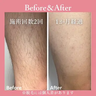 メンズ キッズ 有人型セルフサロン 脱毛/痩身/美顔のその他イメージ