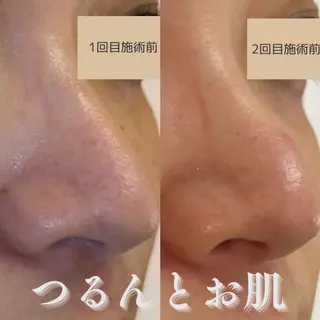 肌質改善×毛穴洗浄 ナスサロ 看護師只野のエステ・リラクイメージ