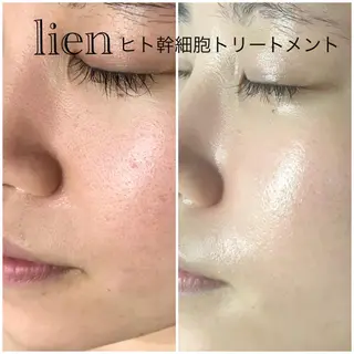 高速脱毛エステ リアンのエステ・リラクイメージ