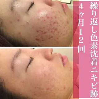 皮膚科より効果あり ⁉️最短ニキビ改善のエステ・リラクイメージ
