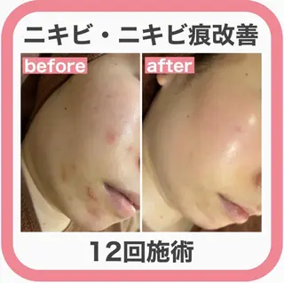 学生ニキビ改善🍀 優しい肌質改善のエステ・リラクイメージ