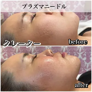 毛穴レス ハーブ& ワックス脱毛×光脱毛のエステ・リラクイメージ