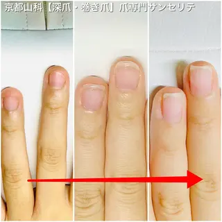 深爪・巻き爪 専門サンセリテのネイルデザイン