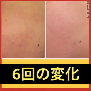 学生ニキビ改善🍀 優しい肌質改善のエステ・リラクイメージ