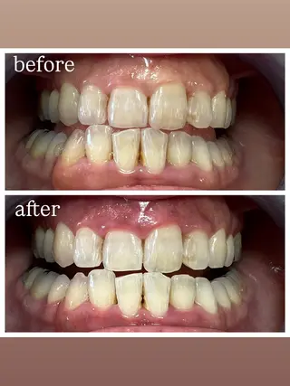 セルフホワイトニング Shineeのエステ・リラクイメージ