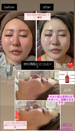 ハーブピーリング/韓国肌管理/フェイシャル/毛穴洗浄/眉毛/顔脱毛【糸脱毛専門】rev所属・肌質改善❤️美眉 脱毛🍒糸脱毛サロンのエステ・リラクイメージ
