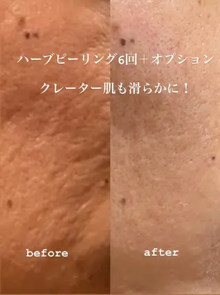 メンズ クレアス勝どき・肌質改善専門店【CREAS Beauty Salon】所属・クレアス勝どき【毛穴 ハーブピーリング専門のエステ・リラクイメージ