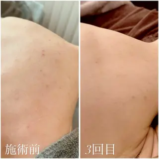 よもぎ蒸し×ハーブピーリング【foi】所属・foi🌿 MIHOのエステ・リラクイメージ