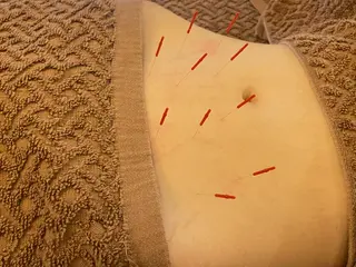 Acupuncture  salon LINOA リノア鍼灸院所属・ヘッドスパ鍼/小顔鍼 耳ツボ 　LINOAのエステ・リラクイメージ