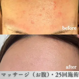 学生ニキビ改善🍀 優しい肌質改善のエステ・リラクイメージ