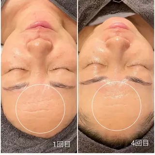 メンズ 毛穴改善ハーブピーリングMinouミヌ心斎橋所属・ミヌ心斎橋 あやめのエステ・リラクイメージ