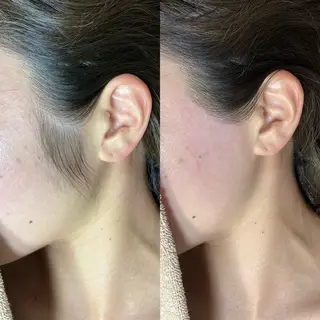 脱毛サロンBloom所属・池袋・即日ツルツル✨ シュガーリングのエステ・リラクイメージ