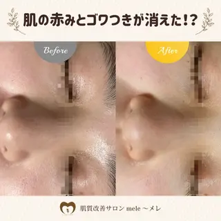 ニキビケア/毛穴/ 赤み/自信の肌✨森園のエステ・リラクイメージ