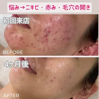 毛穴洗浄/ニキビ 肌質改善サロンのエステ・リラクイメージ