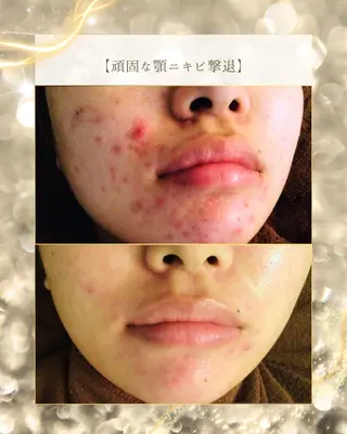 ニキビ/肌質改善専門 Snow skinのエステ・リラクイメージ