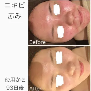 学生ニキビ改善🍀 優しい肌質改善のエステ・リラクイメージ