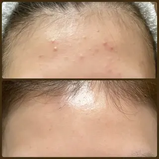 ニキビ・ 肌荒れ専門店のエステ・リラクイメージ