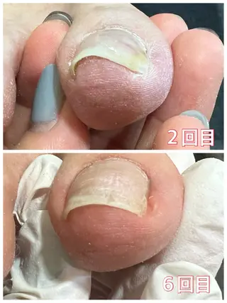 ネイル 巻き爪補正店 堺東店のネイルデザイン