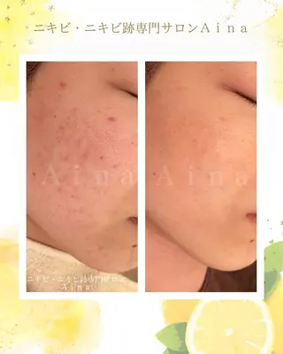 ニキビ跡専門サロン Ａｉｎａのエステ・リラクイメージ
